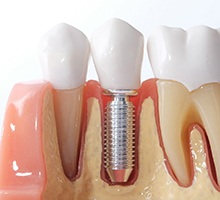 model of a dental implant in the jawbone