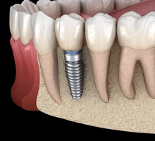 Diagram showing integrated dental implants in Salt Lake City