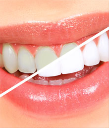 half before, half after teeth whitening result