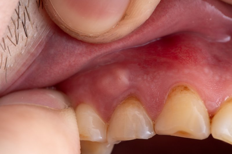 Tooth abscess