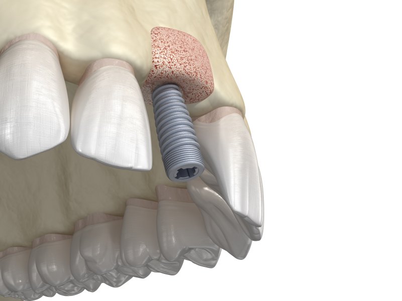 Digital illustration of bone graft