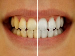Get the bright pearly whites you’ve been dreaming of with teeth whitening from your dentist in Salt Lake City. 